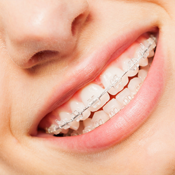 Close up of the mouth of a young adult with clear braces in Minnesota