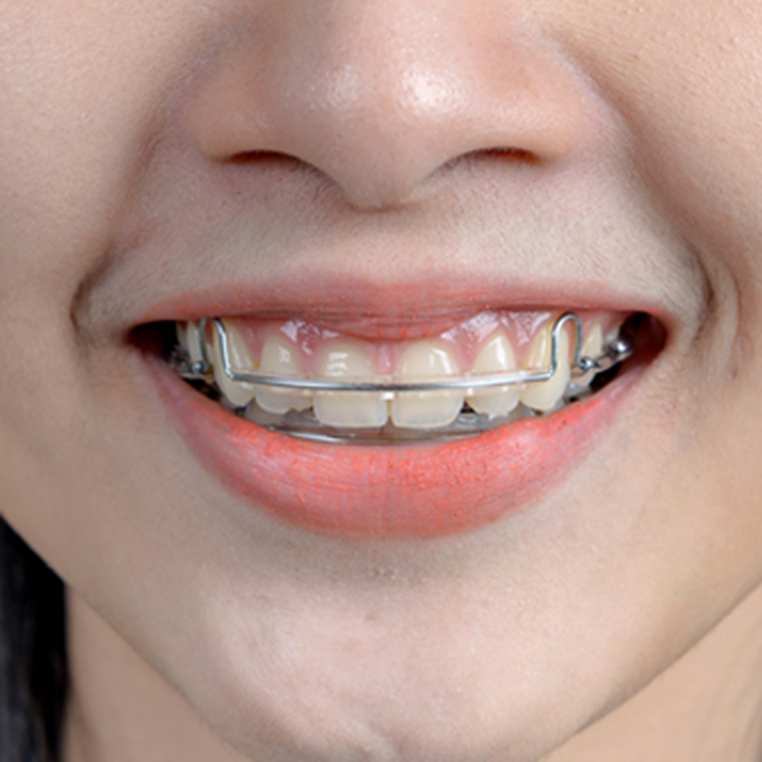 Close up of the mouth of a young adult with removable retainers