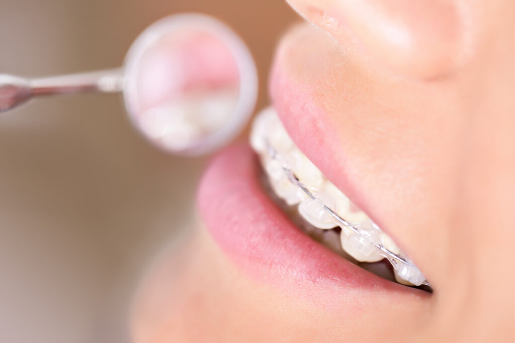 Close up of the smile of a woman with clear braces in Minnetonka.