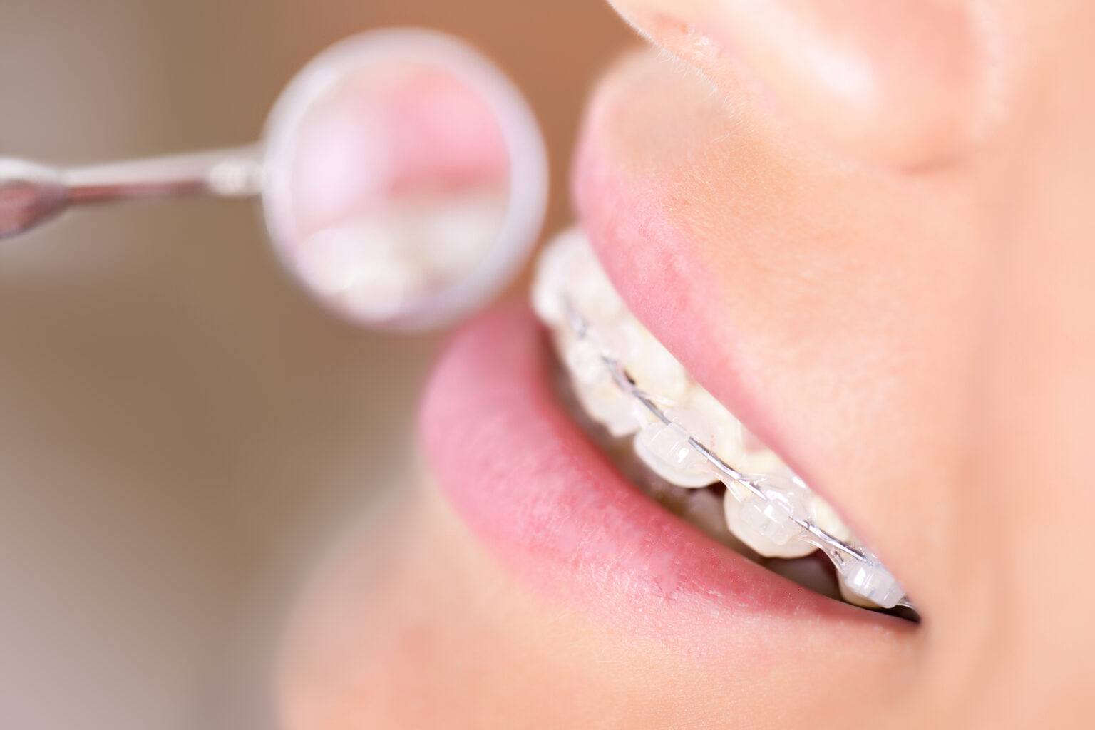 Close up of the smile of a woman with clear braces in Minnetonka.