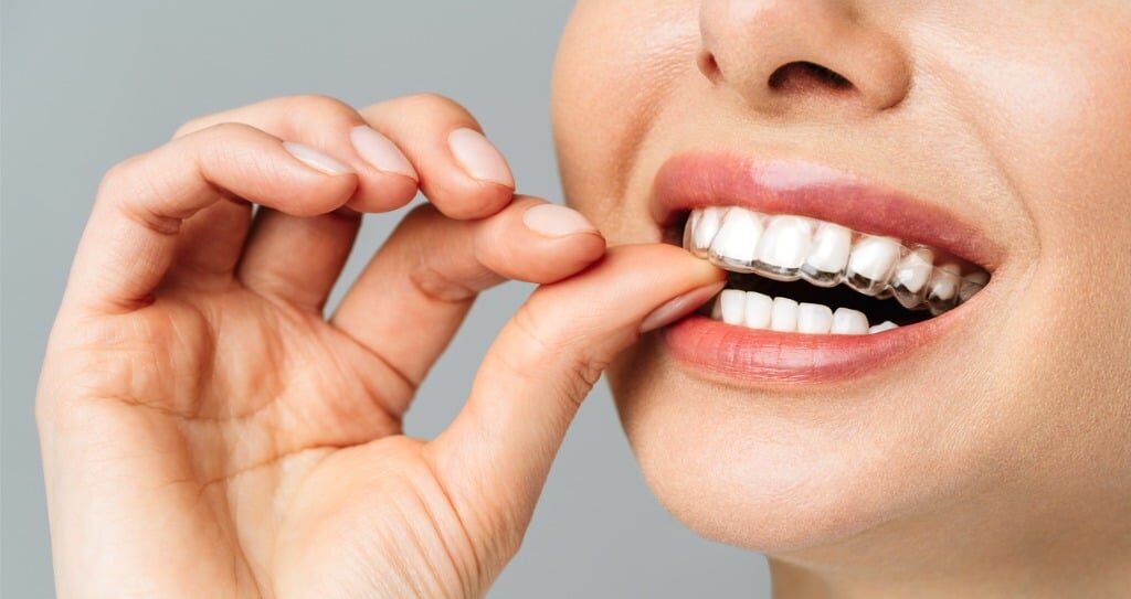 a woman inserting retainers